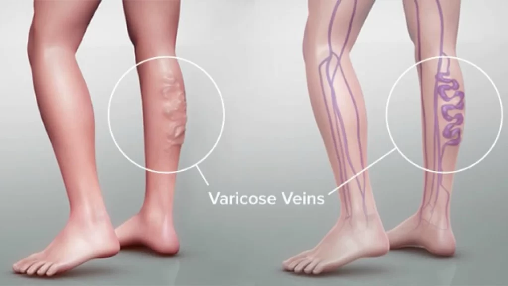 Sclerotherapy, a novel non-surgical vein treatment, is known as one of the finest treatments for spider veins