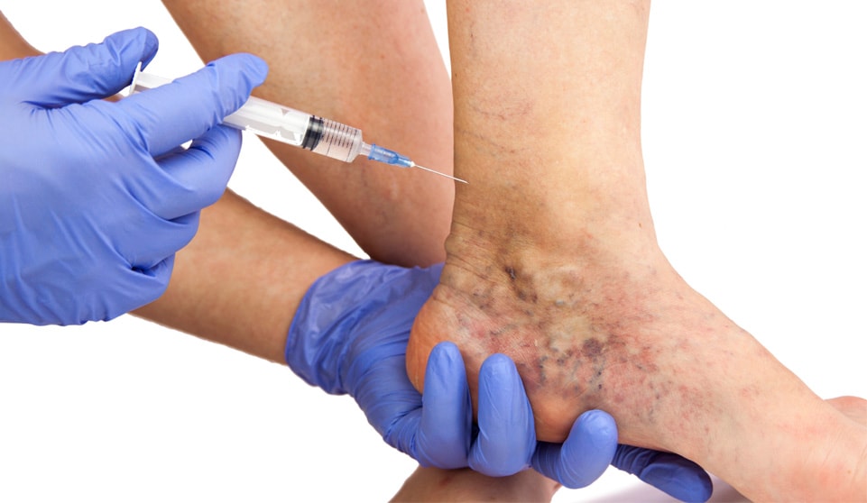 Sclerotherapy injections