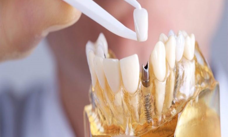 The Benefits of Full Mouth Dental Implants